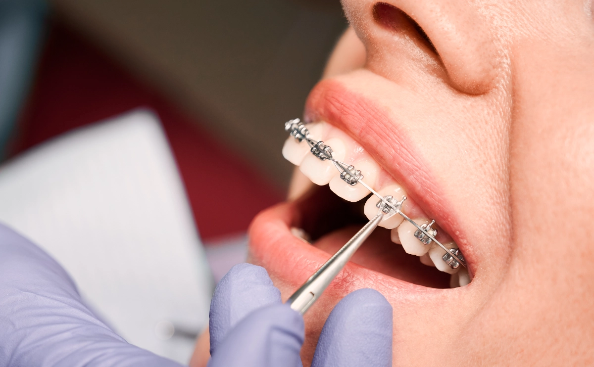 Profesjonalna asysta ortodontyczna – część 1 (teoria + warsztaty)